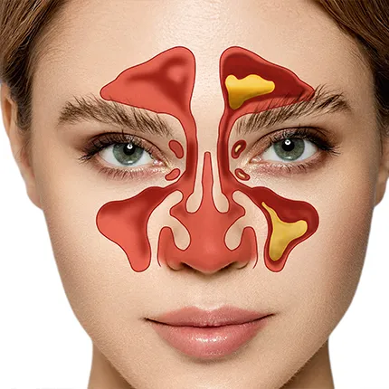 Afecțiuni ale cavității nazale și ale sinusurilor paranazale