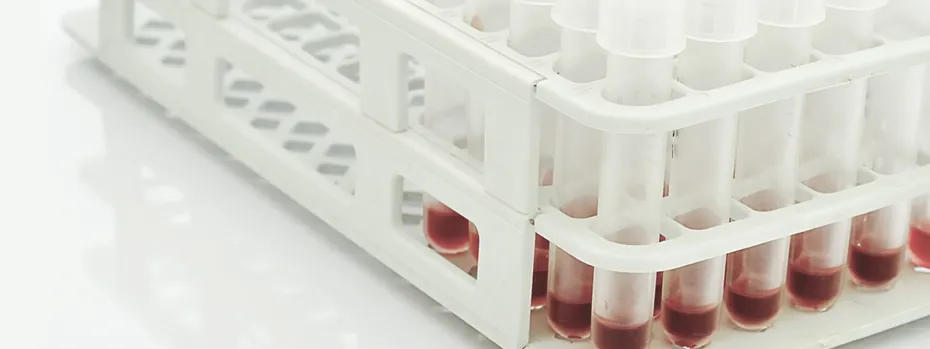 Indikatoren einer Lebererkrankung: Die Leberwerte