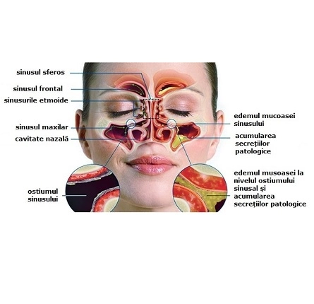 Заболевания полости носа и околоносовых пазух