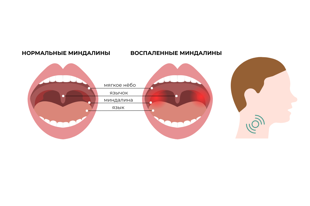 Миндалины 1
