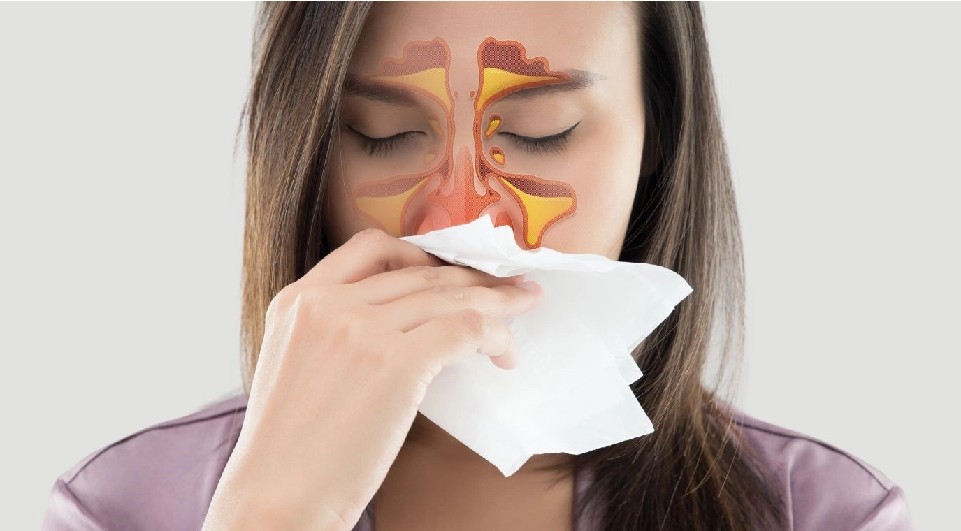 katar, zapalenie zatok, sinupret, co na zapalenie zatok