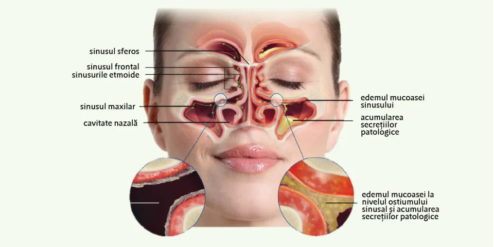 afectiuni ale sinusurilor