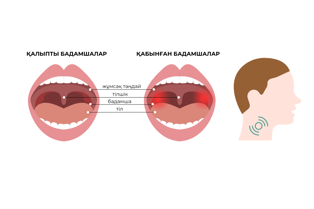 Миндалины 1