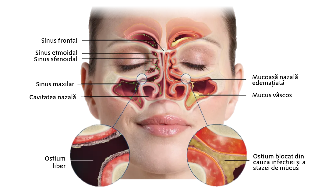 sinuzita cronica