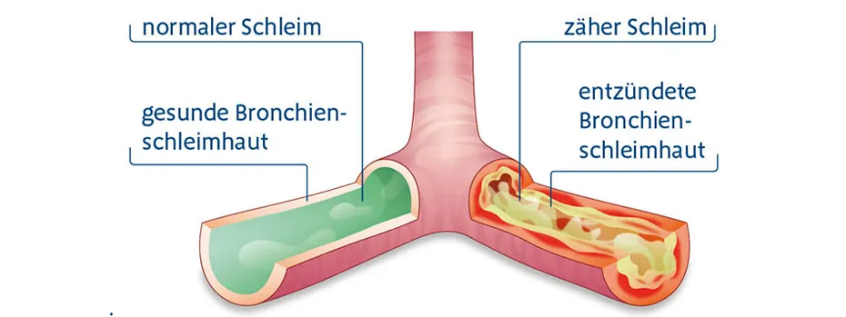 Abgeschlagenheit/ deutliches Krankheitsgefühl