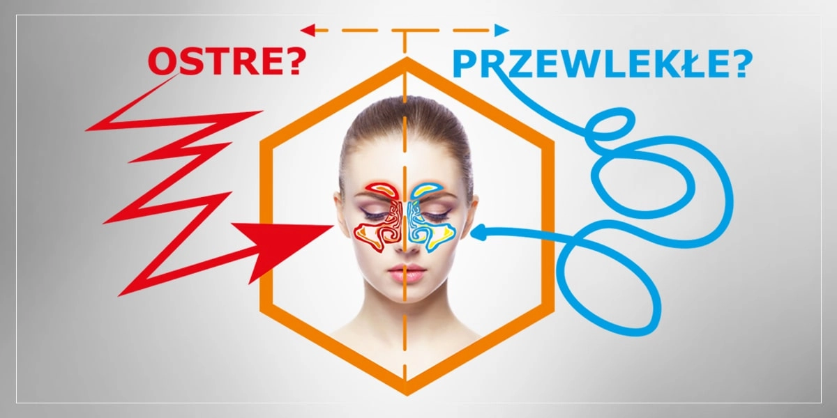 zapalenie zatok, sinupret