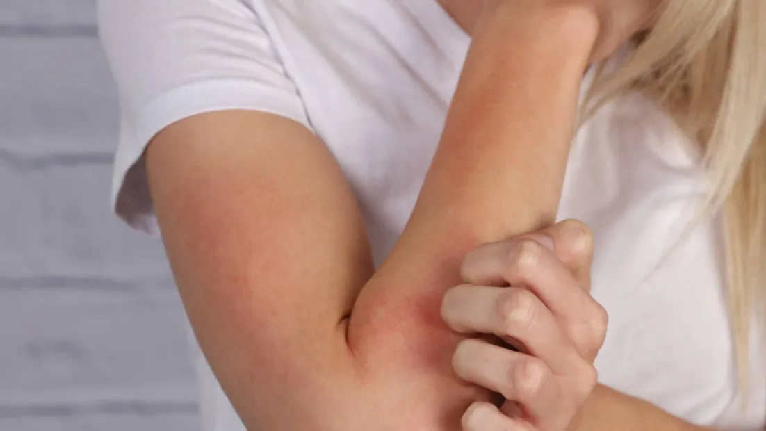 Neurodermitis_Krankheitsbild-und-Behandlung