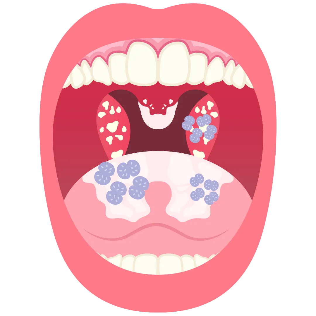 Грибковые инфекции
