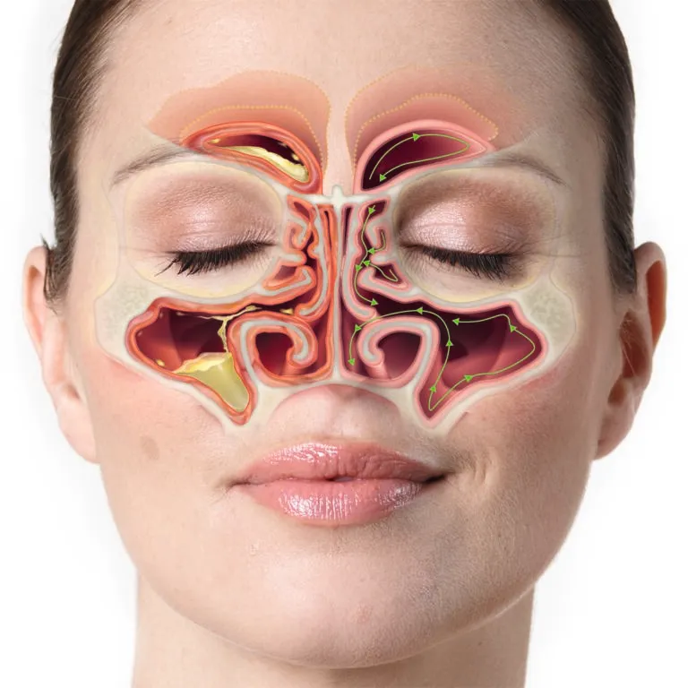 inflamație a sinusurilor