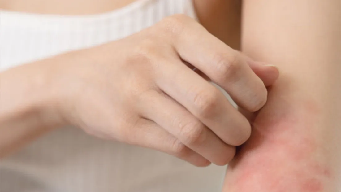 Neurodermitis-Ursachen